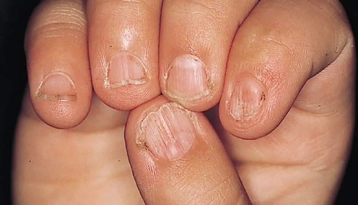 ลักษณะเล็บบอกโรค