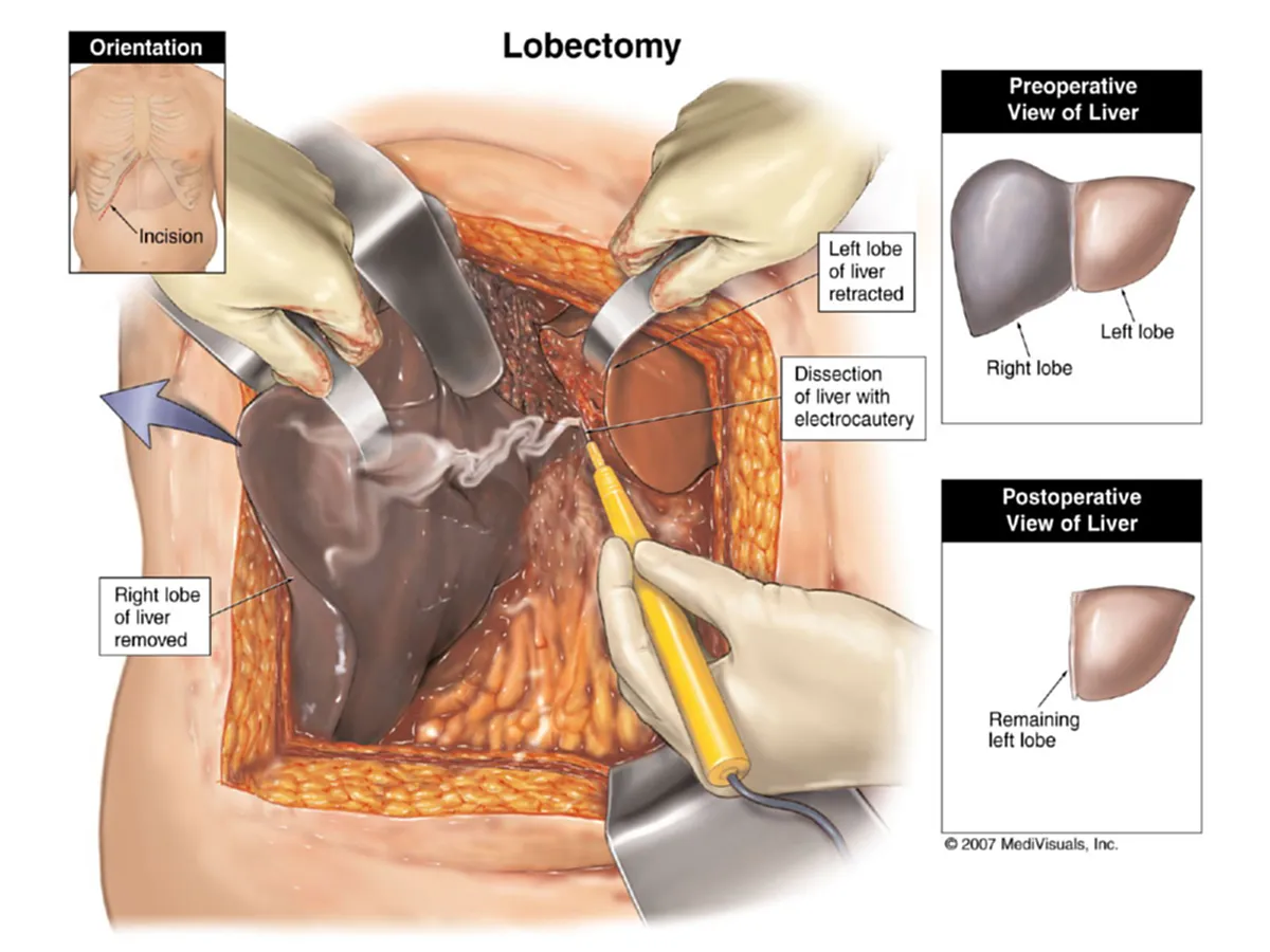 เตือนภัยมะเร็งตับลุกลามเร็ว!!! 10 สัญญาณเตือนโรคมะเร็งตับ เช็กก่อนอย่าปล่อยให้มะเร็งตัวร้ายทำลายสุขภาพ?!!!