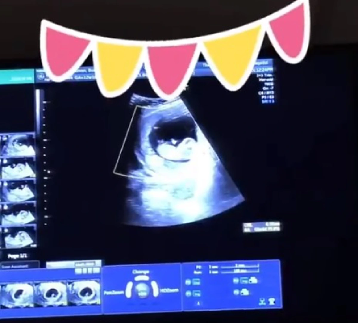 ฝันเเม่นมาก เอ็ม บุษราคัม ท้องลูกคนที่2ได้ลูกสาวสมใจอยาก