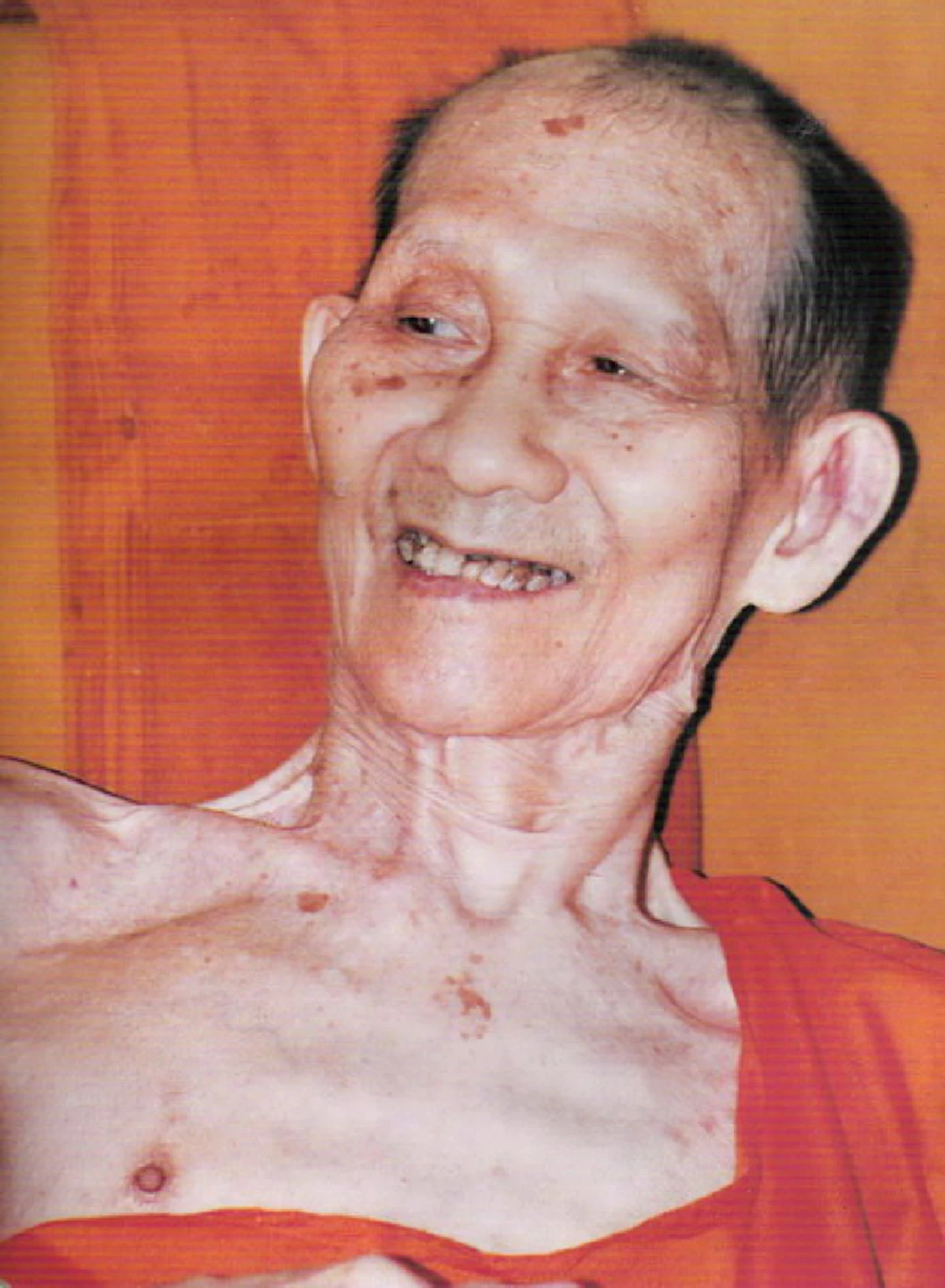 อัศจรรย์..ด้วยสมาธิจิตแห่งบุญบารมี "หลวงพ่อเกษม เขมโก"ผ่าตัดนานนับชั่วโมง ไม่วางยาสลบ นอนนิ่งไม่ไหวติง.ไร้ซึ่งความเจ็บปวด สาธุ..