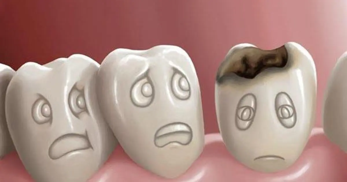 ภาพฟันผุ