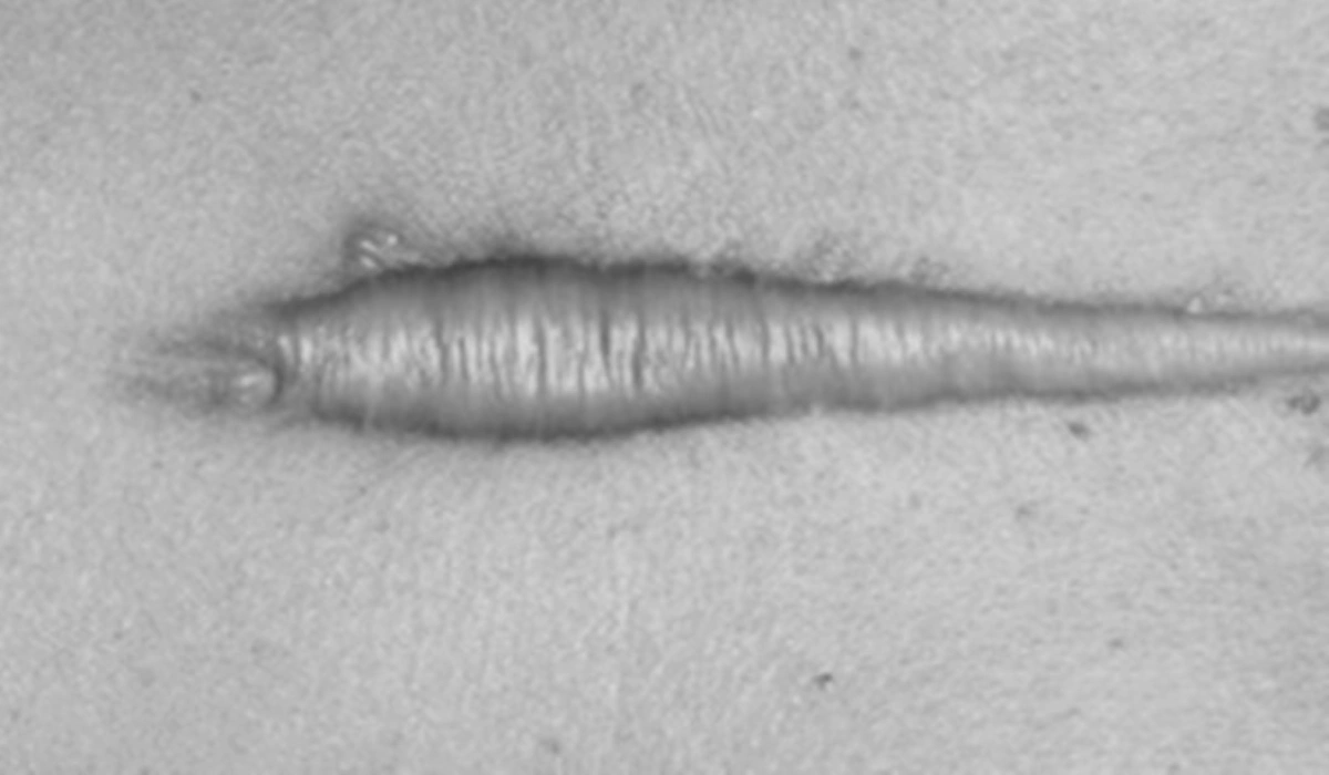 รีบแชร์เก็บไว้เลย!!! "ลบรอยแผลเป็นนูน" ด้วยสูตรสมุนไพรพื้นบ้านใกล้ตัว ง่ายๆ ปลอดภัย บอกลาปัญหากังวลใจได้เลย