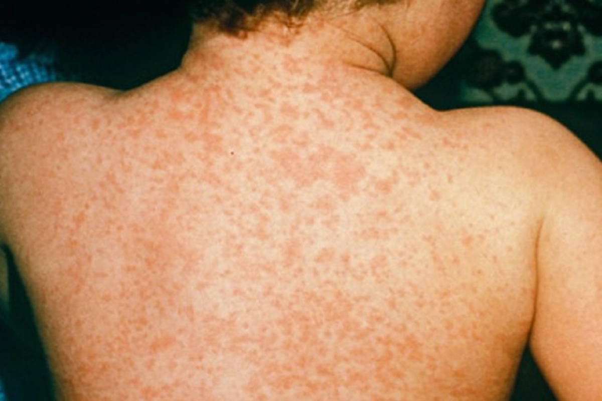 #ห้ามกินเด็ดขาด!! แพทย์เตือน &quot;10 โรค&quot; เสี่ยงติดต่อทางน้ำลาย แค่ใช้หลอดดูดน้ำร่วมกัน ระวังให้ดี! อันตรายใกล้ตัวอย่ามองข้าม!!