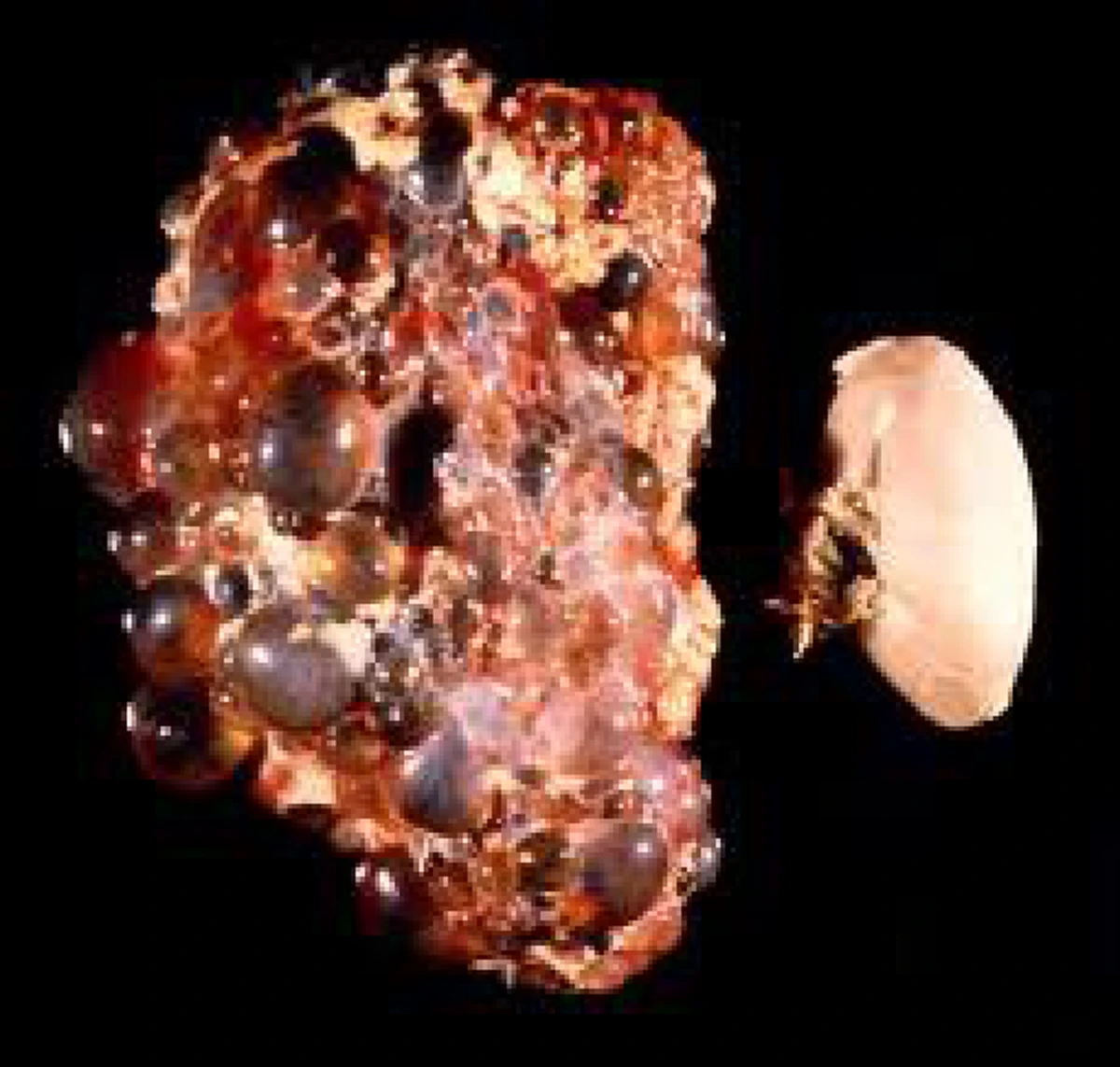 พิชิตความดันโลหิตสูง (ฆาตกรเงียบ)  ด้วยสมุนไพร 5 ชนิด