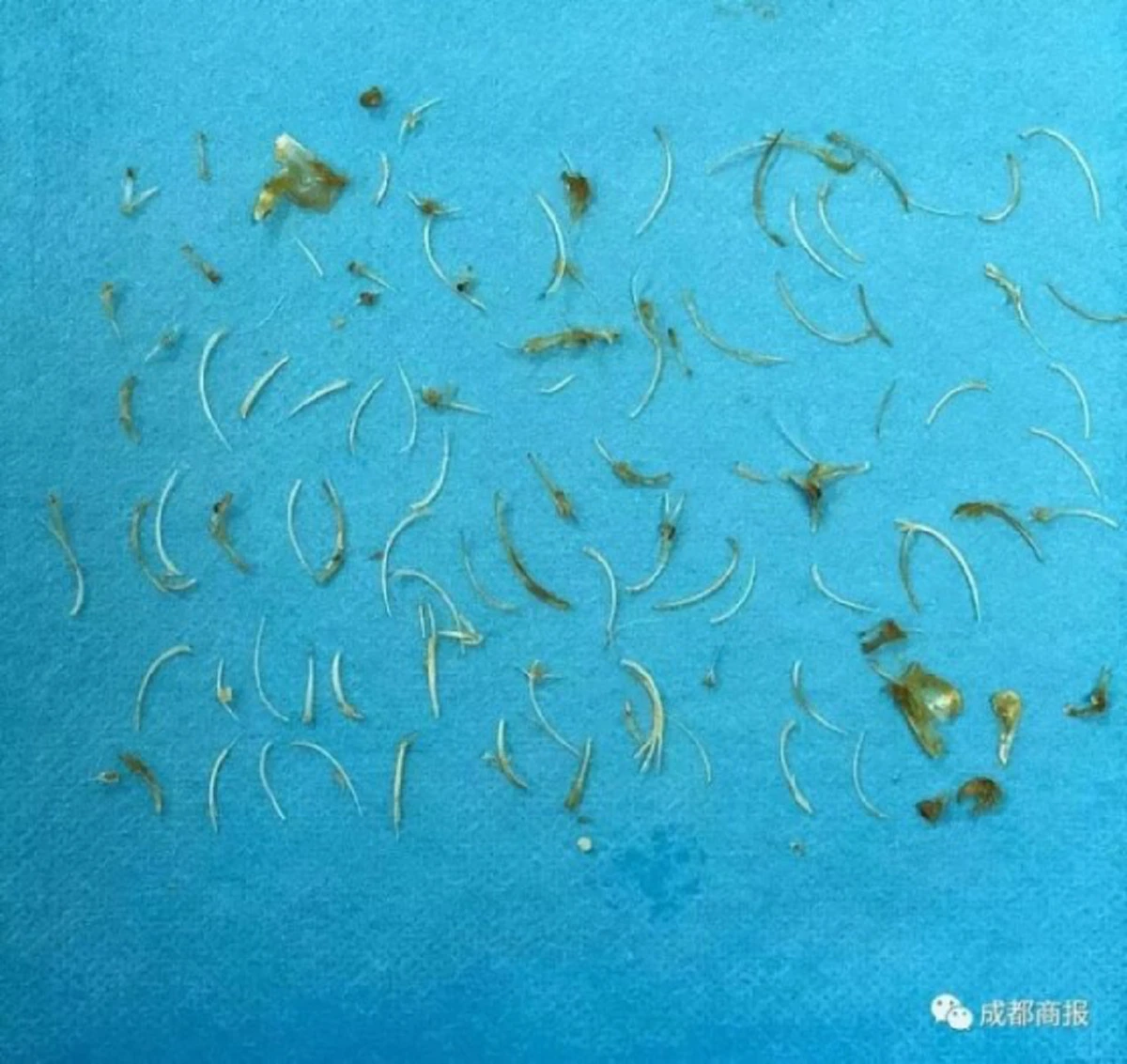 ตะลึงกันทั้งโรงพยาบาล!! "ลุงชาวจีน" วัย 63 ปี "ก้างปลา" ติดค้างในรูทวาร ดึงออกมานับร้อยชิ้น หลังกิน "ซุปปลาคาร์พต้ม" ในงานเลี้ยง!!