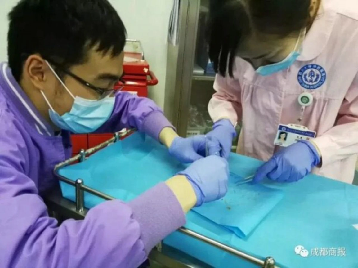 ตะลึงกันทั้งโรงพยาบาล!! "ลุงชาวจีน" วัย 63 ปี "ก้างปลา" ติดค้างในรูทวาร ดึงออกมานับร้อยชิ้น หลังกิน "ซุปปลาคาร์พต้ม" ในงานเลี้ยง!!