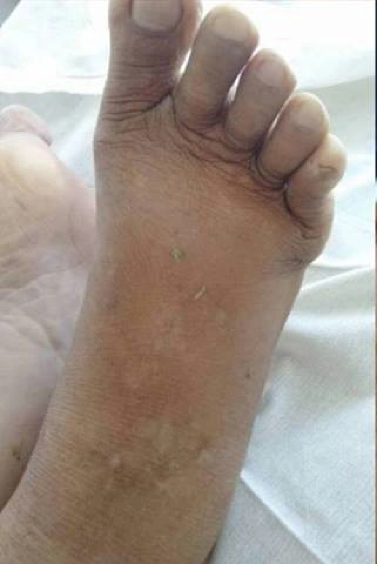 ตะขาบกัดจนถึงแก่ชีวิต