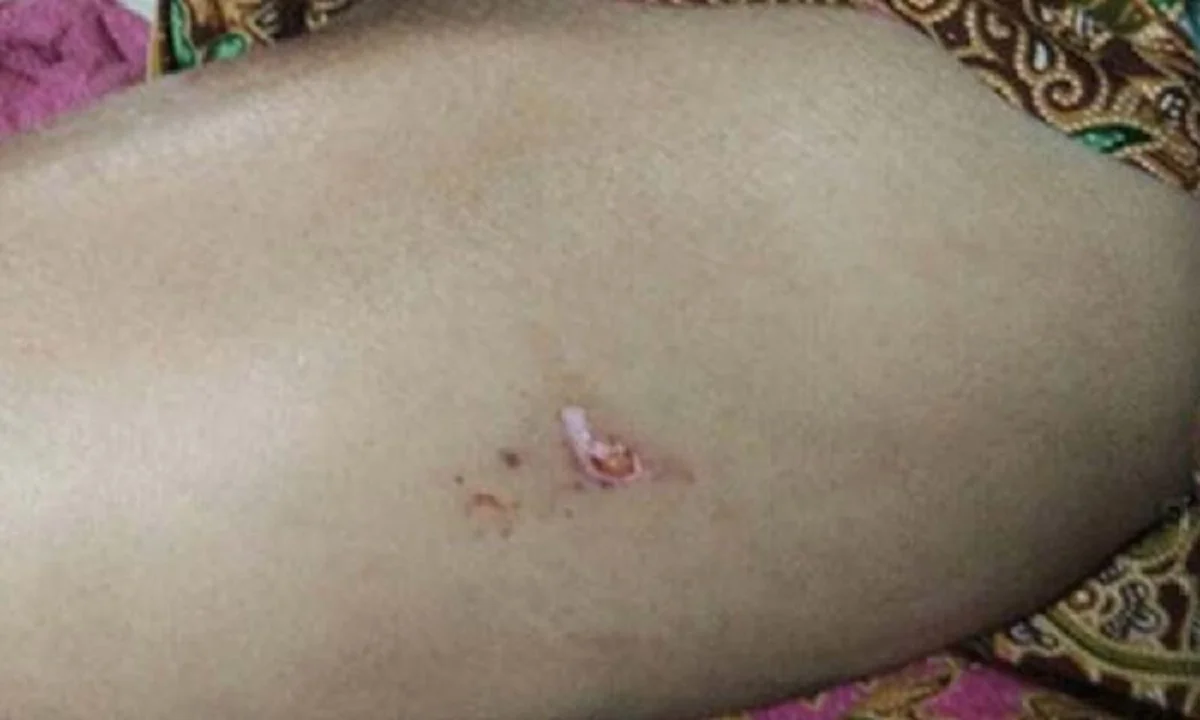 วิธีปฐมพยาบาลเมื่อโดน ตะขาบกัด ได้ผลดีจริง หายเร็วด้วย แชร์เก็บไว้เลย…เผื่อได้ใช้