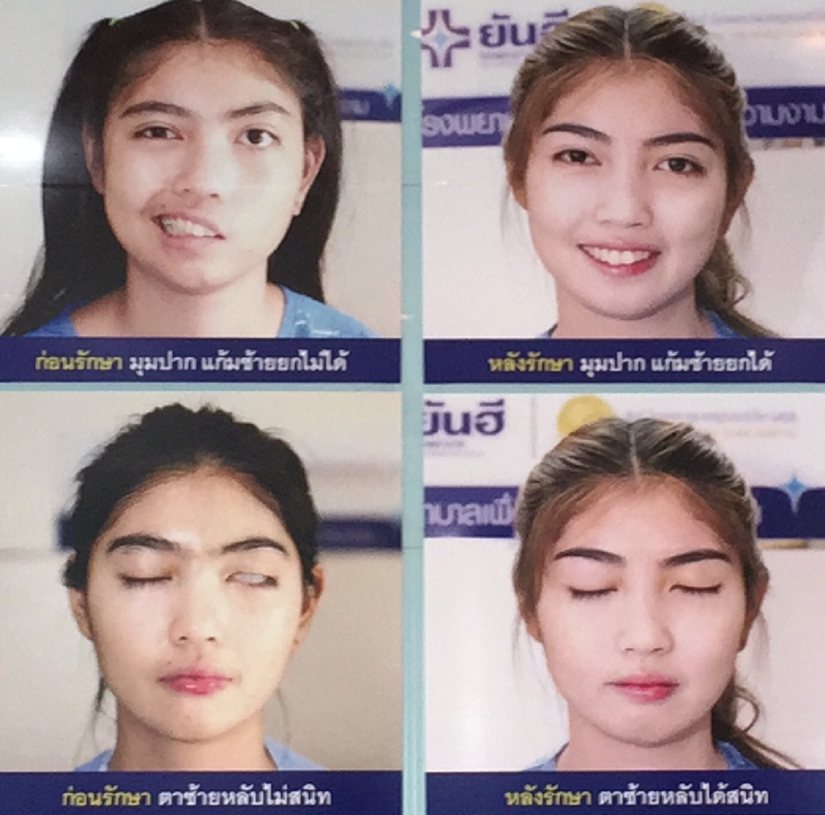 แถลงเป็นทางการ!!! แพทย์ยันฮีอัพเดทอาการล่าสุด "น้องทราย" โดนครูพละปาแก้วใส่หน้าจนปากเบี้ยว ร่วมอนุโมทนาบุญทุกฝ่ายคืนชีวิตงดงามให้เธอ!?!