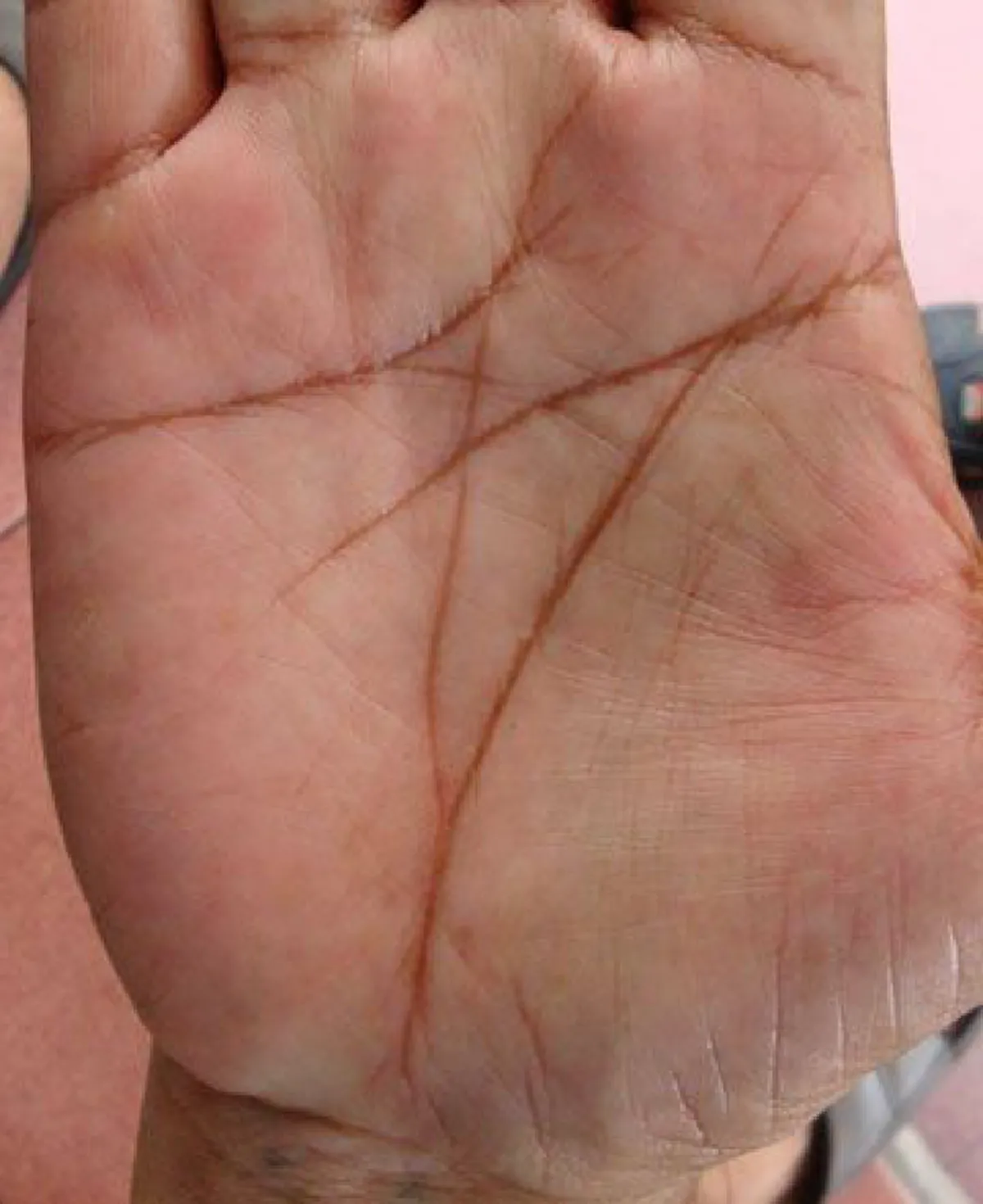 เส้นกากบาท สัญลักษณ์บนฝ่ามือ ที่บอกว่า คุณคือคนที่โชคดีที่สุด!