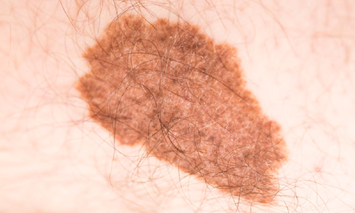 เช็คกันด่วนๆเลย!!! กับ 9 ตำแหน่ง "ปานมงคล" หากใครมีบนร่างกายตามจุดต่อไปนี้... ถือว่าโชคดี จะร่ำรวย ชีวิตสุขสบาย!?