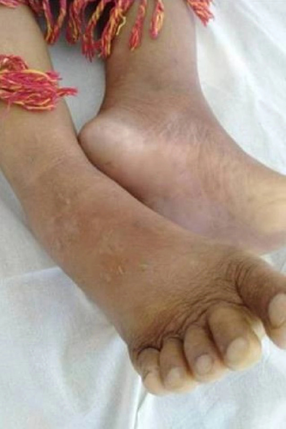 ตะขาบกัด เสียชีวิต