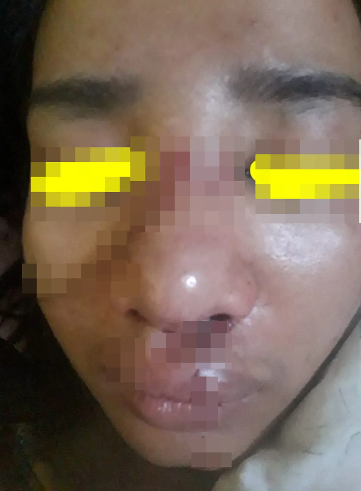 สาวโพสต์เตือน อ้างหนุ่มตามจีบแต่ไม่เล่นด้วย โดนตบเลือดอาบ