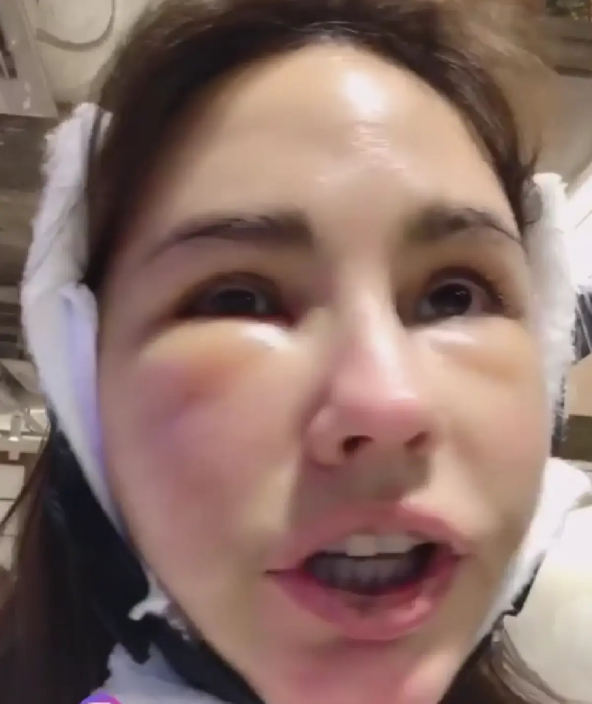 \"แหม่ม  วิชุดา\" บินตรงเกาหลีรอบ 2 อัพหน้าใหม่ พร้อมปลูกผม 3,000 เส้น