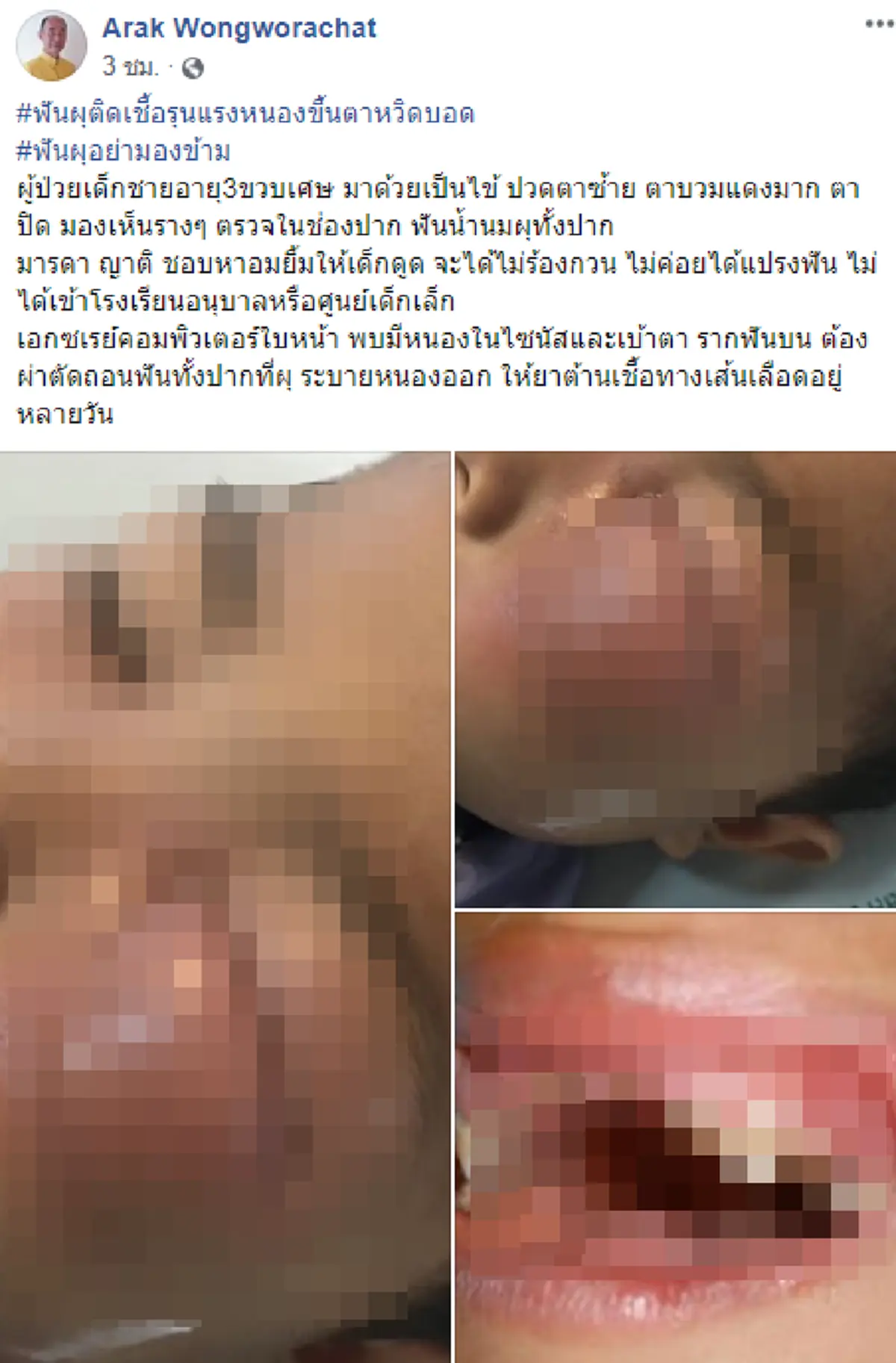 หนูน้อยวัย 3 ขวบ หวิดตาปอดเพราะฟันผุ