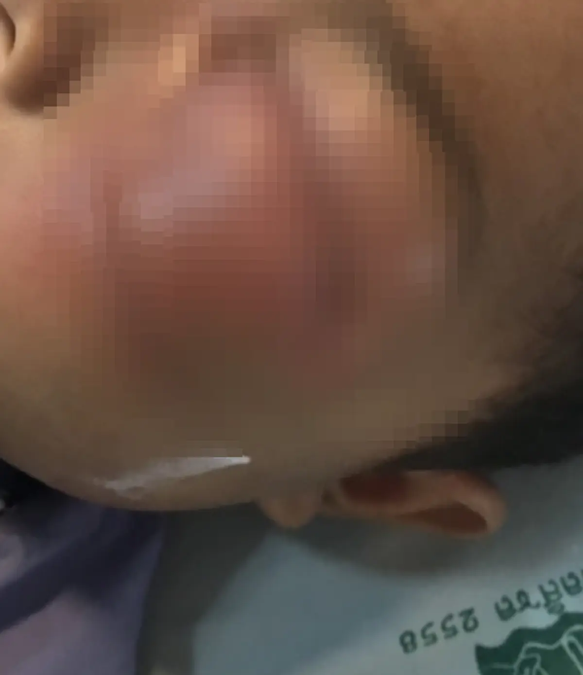 หนูน้อยวัย 3 ขวบ หวิดตาปอดเพราะฟันผุ