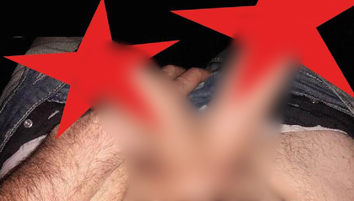 มารู้จักกับภาวะ Diphallia มีโอกาสเกิด 1 ใน 5.5 ล้านคนเท่านั้น!!