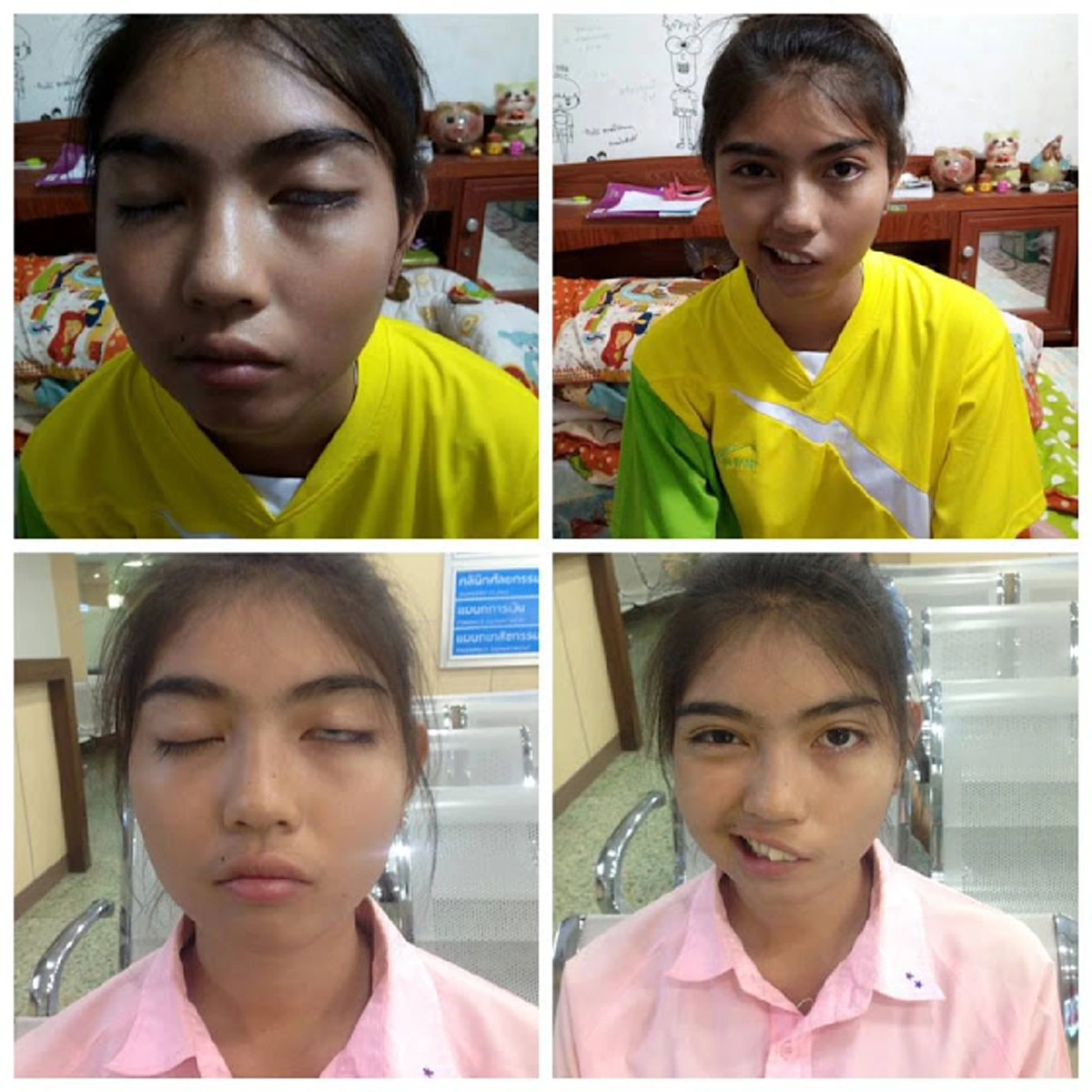 แถลงเป็นทางการ!!! แพทย์ยันฮีอัพเดทอาการล่าสุด "น้องทราย" โดนครูพละปาแก้วใส่หน้าจนปากเบี้ยว ร่วมอนุโมทนาบุญทุกฝ่ายคืนชีวิตงดงามให้เธอ!?!