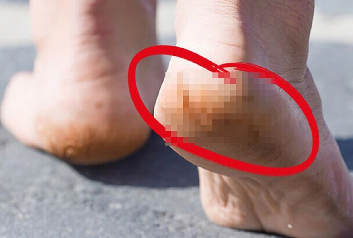 เผยสูตรสครับรักษา "ส้นเท้าแตก" ทำง่าย ไม่ต้องเสียเงินซื้อครีมแพงๆ