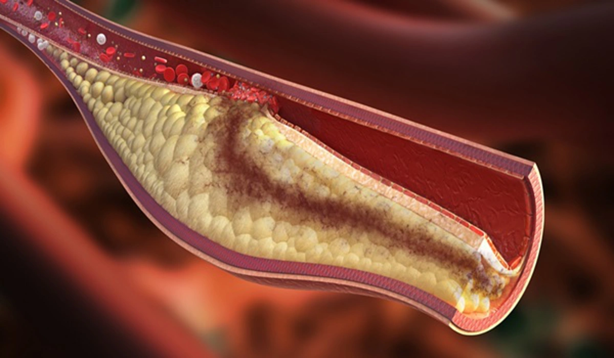 อยากสุขภาพดีต้องดู!!! สูตรน้ำผักสมุนไพรช่วยดักจับและล้างไขมันในเส้นเลือด ลดความดันและน้ำหนัก ทำเองได้ง่ายๆ เห็นผลแน่นอน