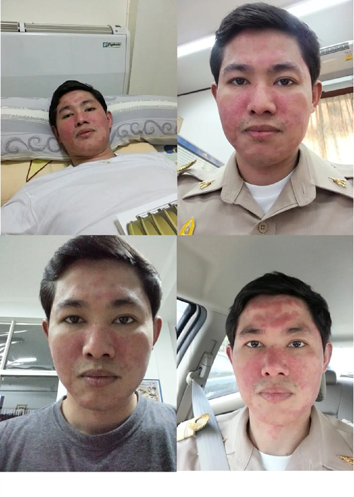 หนุ่มเป็นโรคพุ่มพวง เกือบเสียชีวิตถึง2ครั้ง ก่อนฮึดสู้ลงแข่งวิ่งจนชนะโรคภัย
