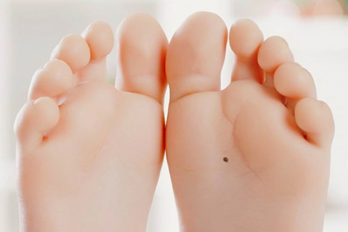 รู้แล้วบอกต่อ!! ตำแหน่ง "ไฝ" ตามความเชื่อโบราณ ที่ส่งผลต่อชีวิตแบบไม่รู้ตัว