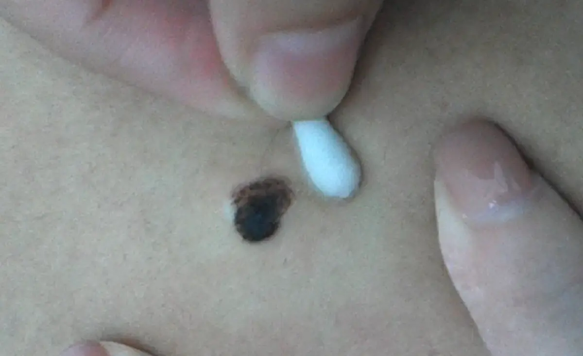 รู้แล้วบอกต่อ!! วิธีกำจัด ไฝ ขี้แมลงวัน แสนง่ายที่ทำเองได้ราคาสบายกระเป๋า