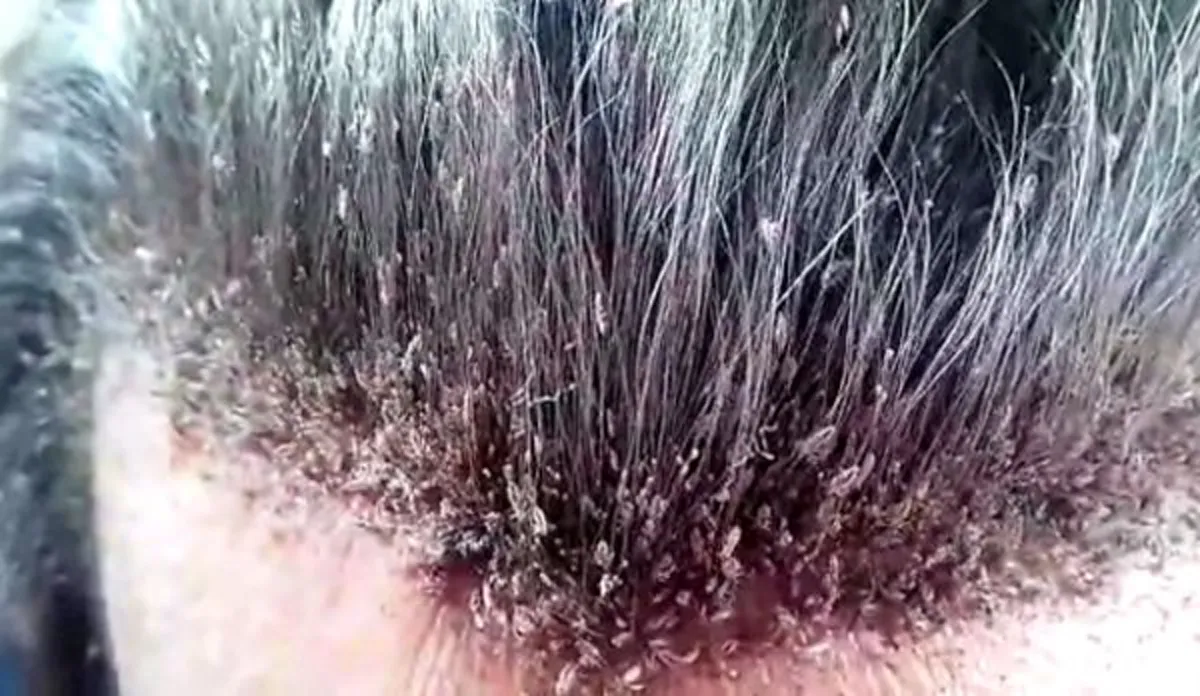 ทำครั้งเดียวหายเกลี้ยง!! เผยสูตรเด็ดเคล็ดลับ วิธีกำจัด "เหา" "แบบหายขาด" โดยที่แพทย์ไม่บอกคุณ ไม่ต้องโกนหัวทิ้งอีกต่อไป!!!! (แชร์เก็บไว้เลย)