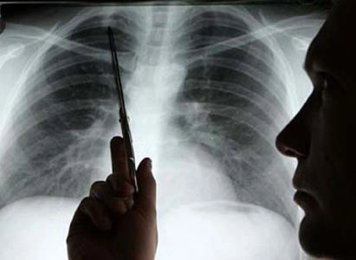 แพทย์ย้ำหนัก!!! ปวดหลังอย่าชะล่าใจ นี้คือสัญญาณเตือนจากร่างกาย รู้ทันโรค อ่านด่วน!!!