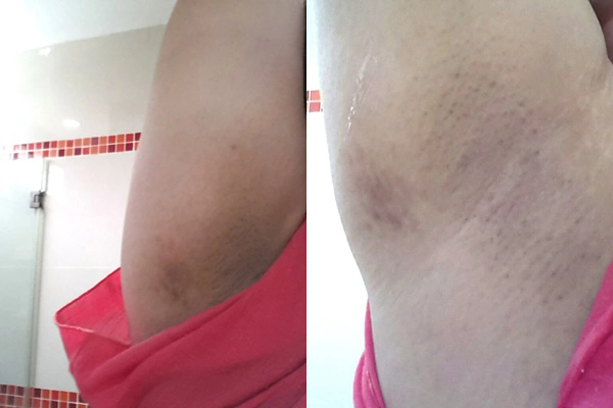 ในที่สุดก็หาเจอ ! สุดยอดเคล็ดลับ ทำให้  "รักแร้ขาว" ใช้เวลาแค่ 5 นาที !! แถมควักกระเป๋าจ่ายเงินไม่ถึง 50 บาท  บอกเลยรีบจดแล้วทำ !! (ชมภาพ)