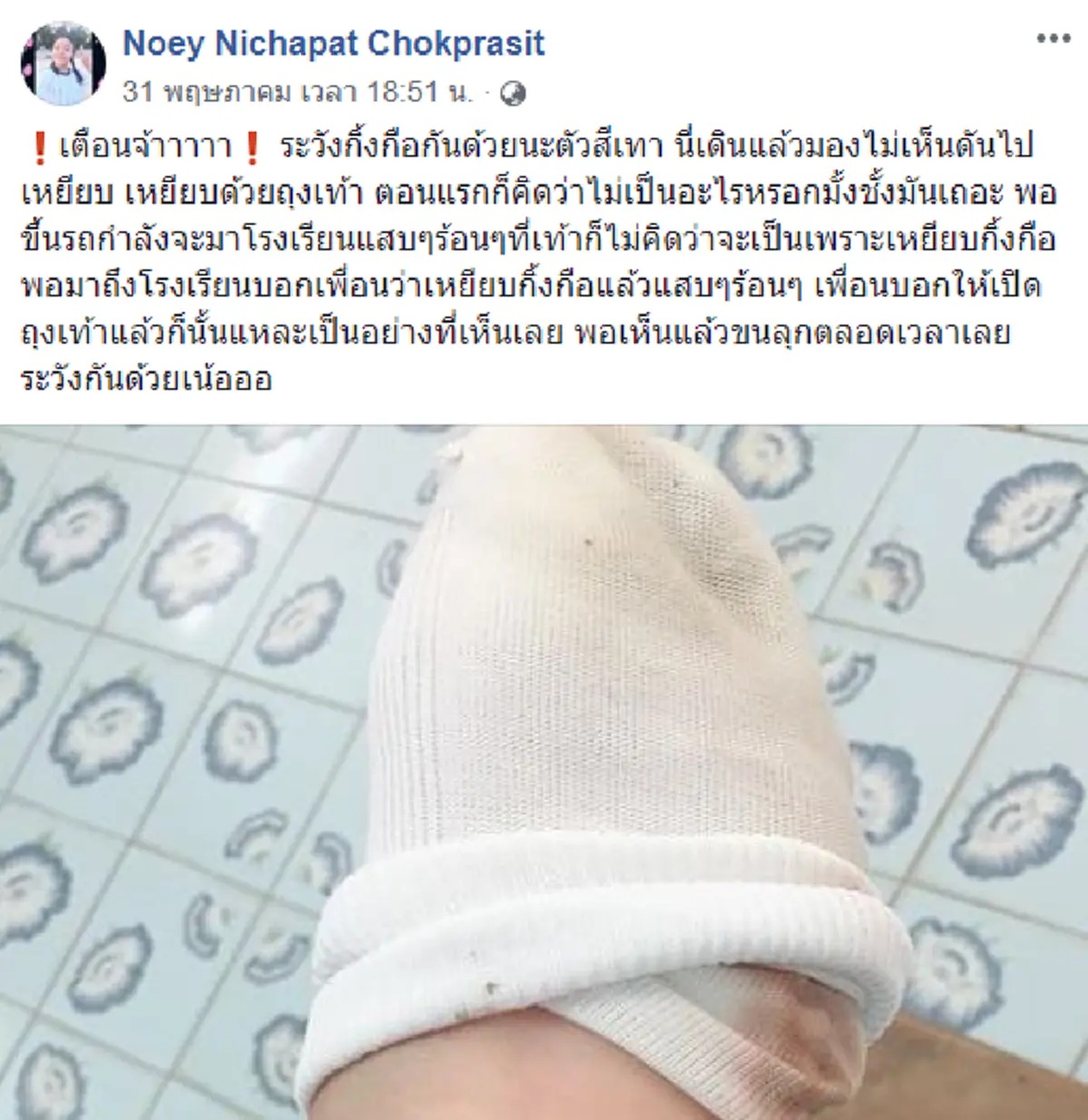 อันตราย..เตือนภัยหน้าฝน!! "กิ้งกือสีเทา" ตัวเล็กแต่พิษร้ายแรง โดนแล้วผิวไหม้ ปวดแสบปวดร้อน!! (มีคลิป)