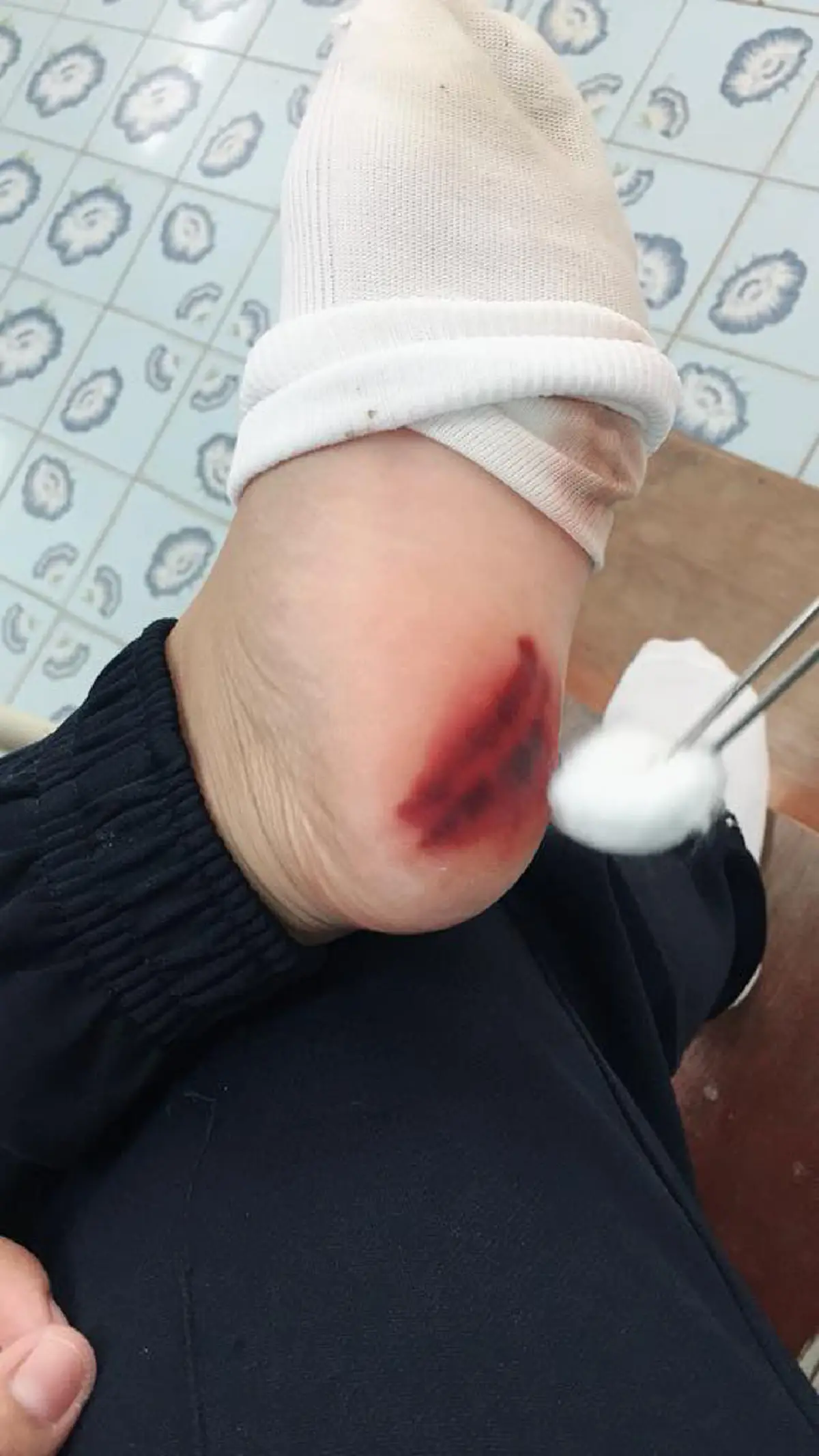 อันตราย..เตือนภัยหน้าฝน!! "กิ้งกือสีเทา" ตัวเล็กแต่พิษร้ายแรง โดนแล้วผิวไหม้ ปวดแสบปวดร้อน!! (มีคลิป)