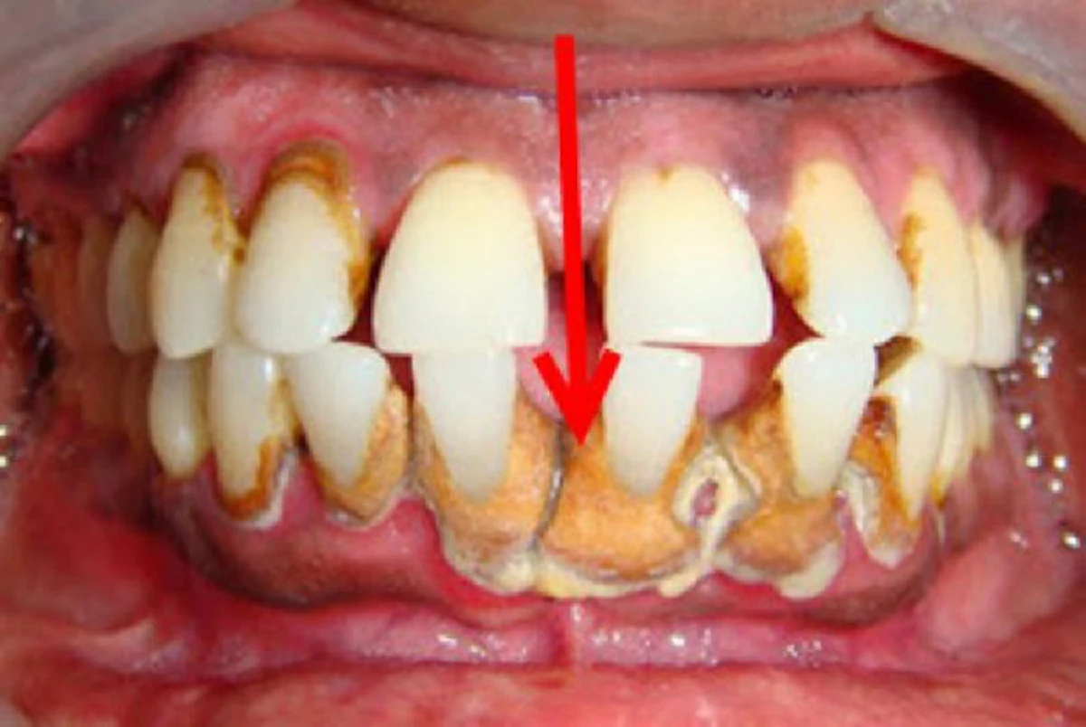 คราบหินปูน