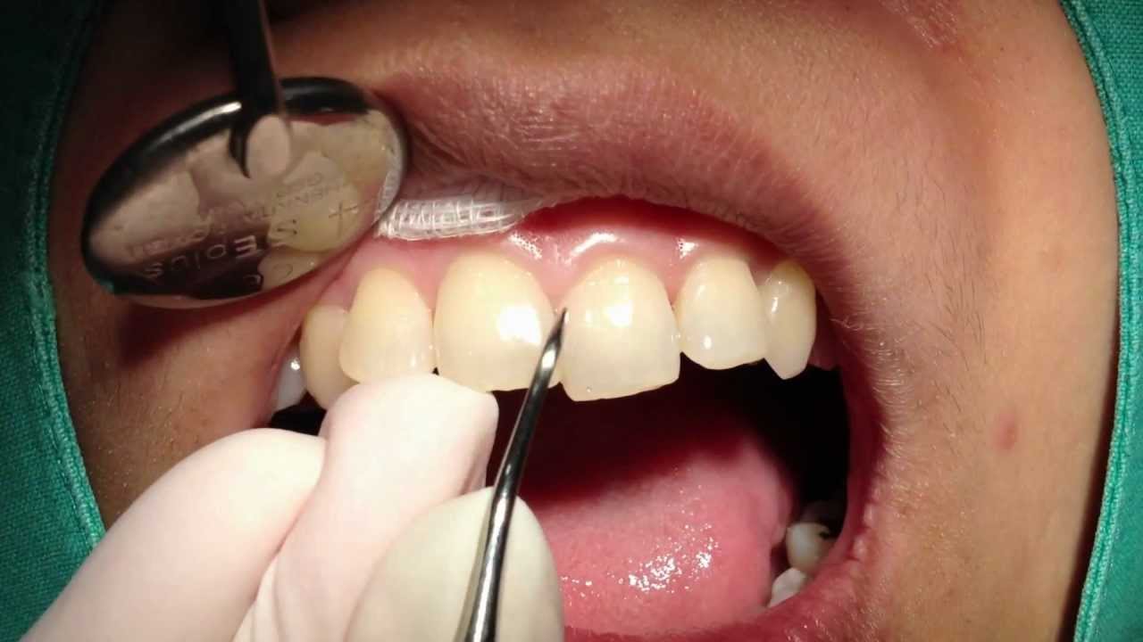 เผยสูตร 5 วิธีเด็ด ขจัดคราบหินปูนด้วยตัวเอง ที่คุณไม่เคยรู้มาก่อน เลิกหาหมอ ไม่ต้องเจ็บตัวอีกต่อไป!!! (คลิป)