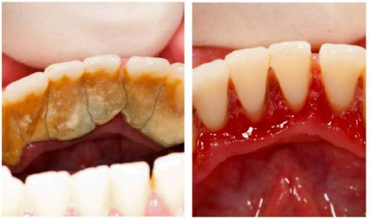 เผยสูตร 5 วิธีเด็ด ขจัดคราบหินปูนด้วยตัวเอง ที่คุณไม่เคยรู้มาก่อน เลิกหาหมอ ไม่ต้องเจ็บตัวอีกต่อไป!!! (คลิป)