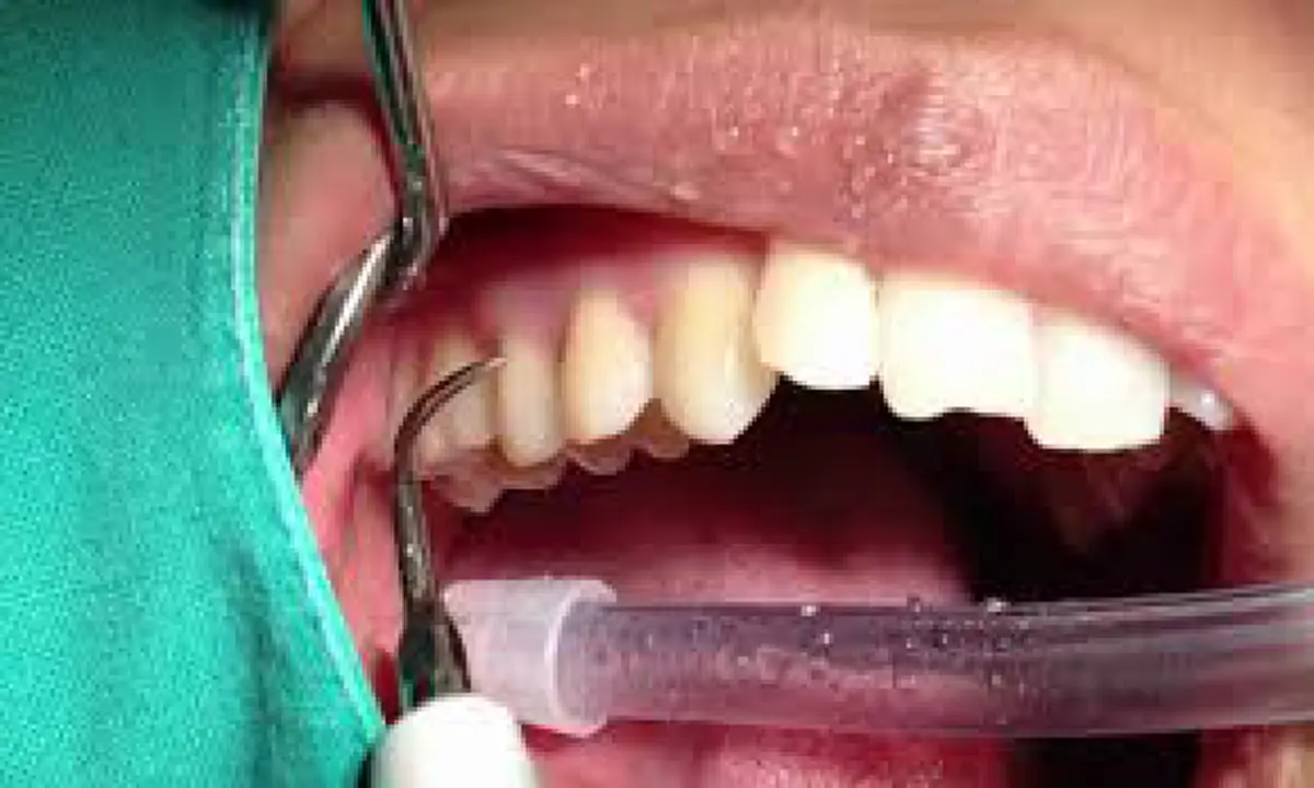 เผยสูตร 5 วิธีเด็ด ขจัดคราบหินปูนด้วยตัวเอง ที่คุณไม่เคยรู้มาก่อน เลิกหาหมอ ไม่ต้องเจ็บตัวอีกต่อไป!!! (คลิป)