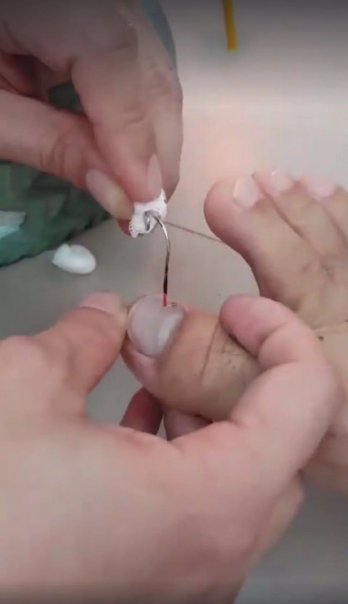 สาวโพสต์คลิป วิธีแก้ปัญหาเล็บฝัง เล็บม่วง ด้วยวิธีบ้านๆ ไม่ต้องทนปวดอีกต่อไป