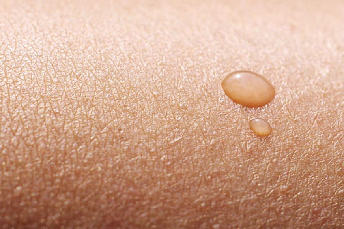 โซดาล้างหน้า รักษาสิวหายเกลี้ยง รูขุมขนกระชับ