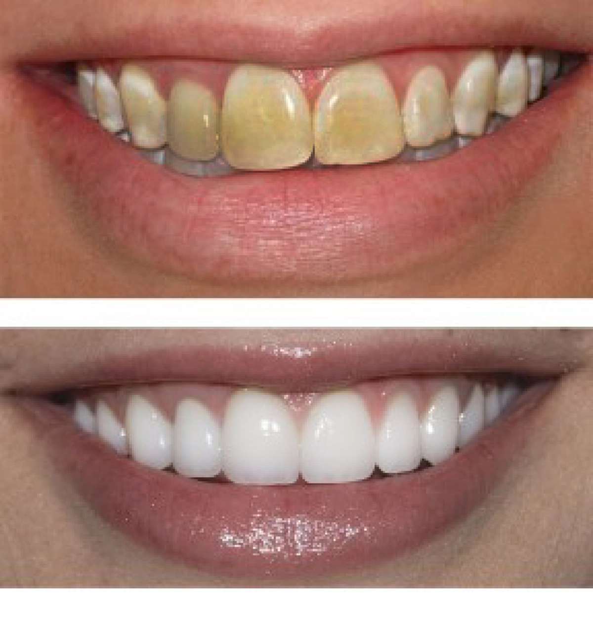 7 วิธีแก้ฟันเหลือง