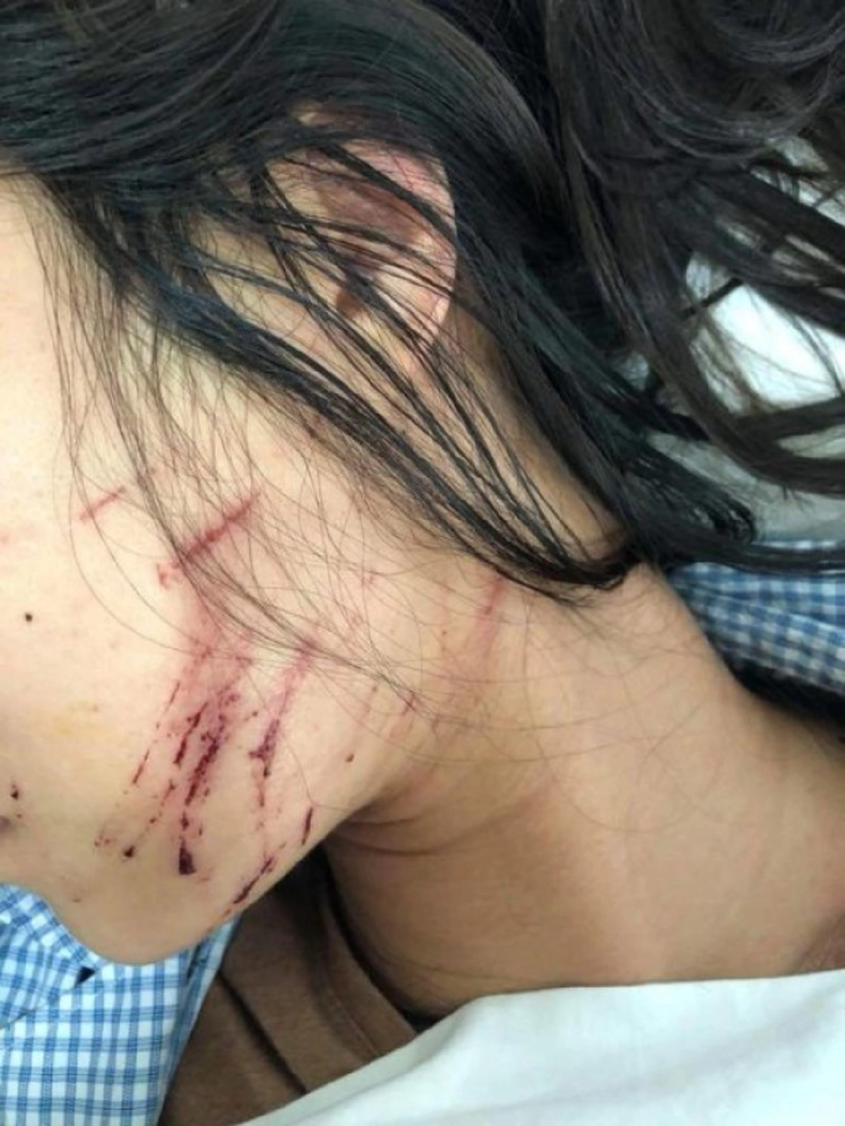 โหดเหี้ยมเกินมนุษย์ !! เผยภาพล่าสุด "กิ๊กสาว" หลังโดน "ภรรยาหลวง" ราดน้ำปลาโรยพริกป่น แผลเต็มตัว สภาพเละไม่เหลือชิ้นดี !! (ชมภาพ)