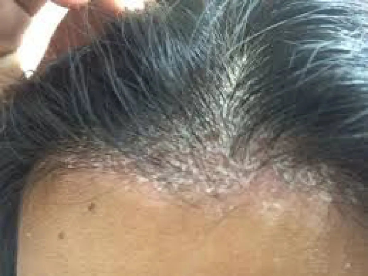 อันตรายกว่าที่คิด 10 ผลร้าย การนอนผมเปียก แหล่งรวมแบคทีเรียขนาดแท้