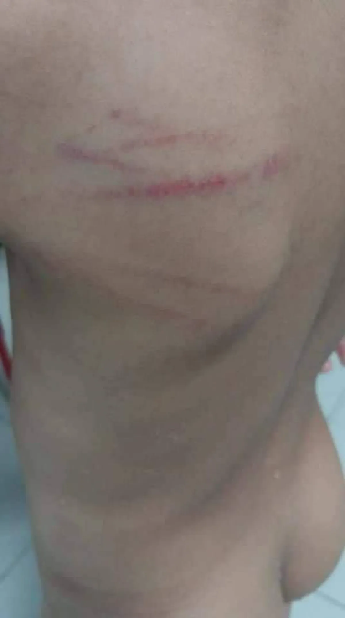 ผู้ปกครองรับไม่ได้ เด็กนักเรียน ป.1 อายุ 6 ขวบ ถูกอาจารย์ฟาดไม่ยั้ง กับเหตุผลที่ฟังดูไม่ขึ้น