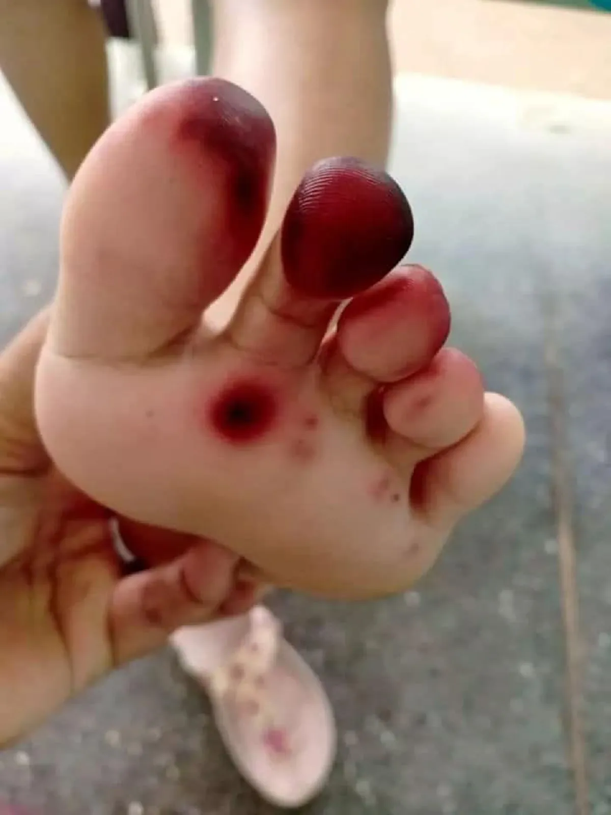 แม่โพสต์เตือนอุทาหรณ์ ต้องเช็ครองเท้าผ้าใบลูกน้อยทุกครั้ง อันตรายที่มากับหน้าฝน