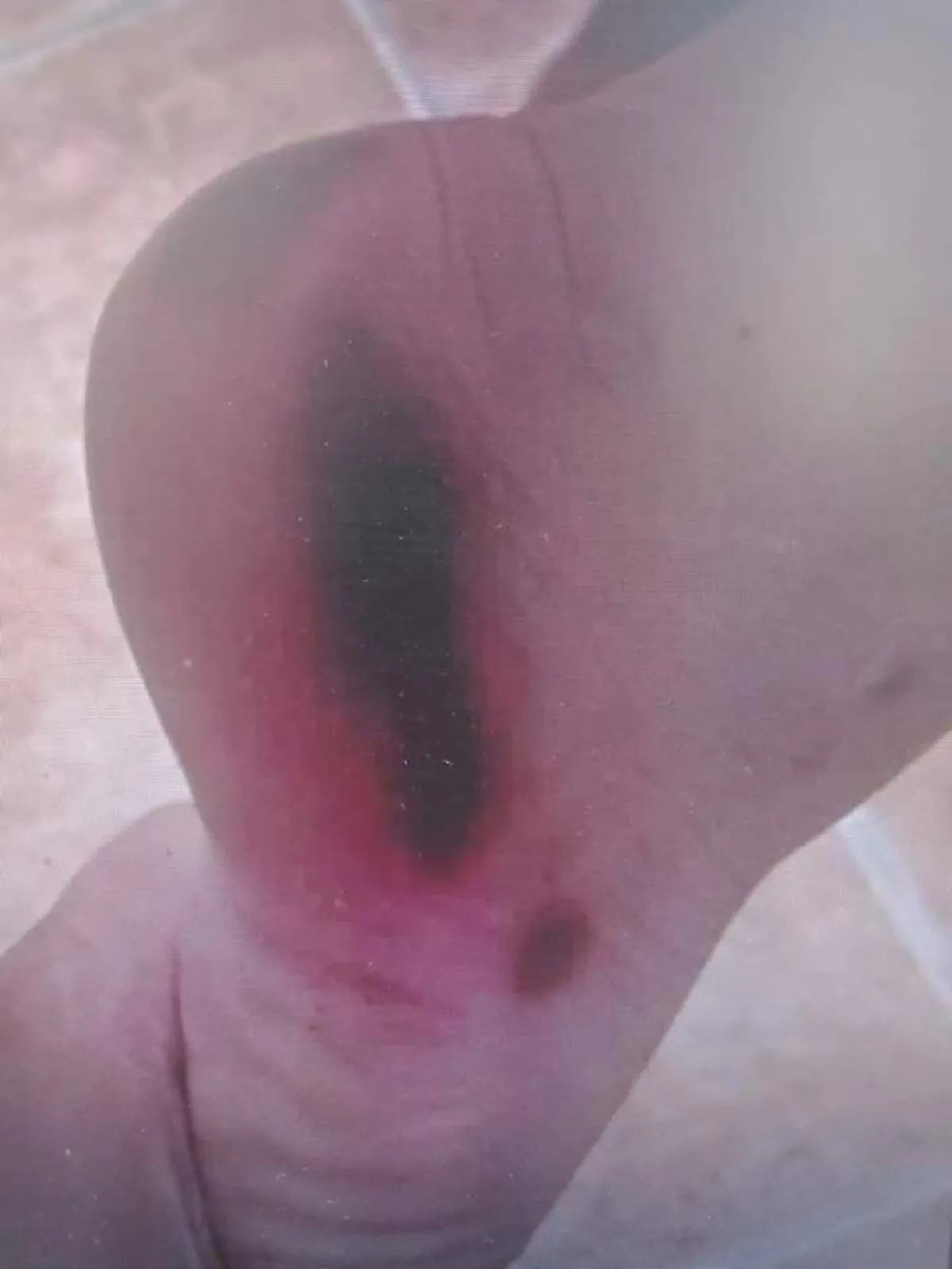 เฉลยแล้ว สาเหตุแผลไหม้แดงเถือกบนเท้าหนูน้อย หลังสัมผัสกิ้งกือที่ซ่อนอยู่ในรองเท้า