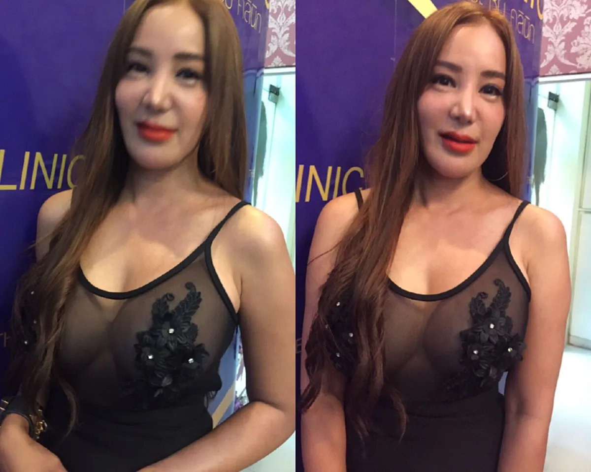 เปิ้ล ไอริณ ยอมรับเสพติดศัลยกรรม20ปี จนถูกสังคมด่าว่าปลอมทั้งตัว