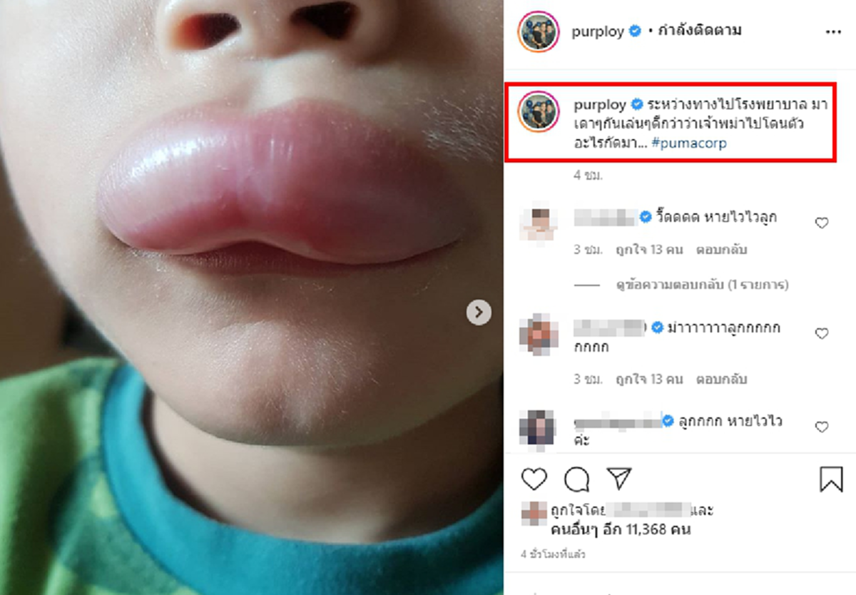 พลอย อดีตภรรยา ปีเตอร์ คอร์ป เผยภาพลูกชายน้องพูม่า ปากบวมฉึ่ง ก่อนเฉลยใครเป็นคนทำ