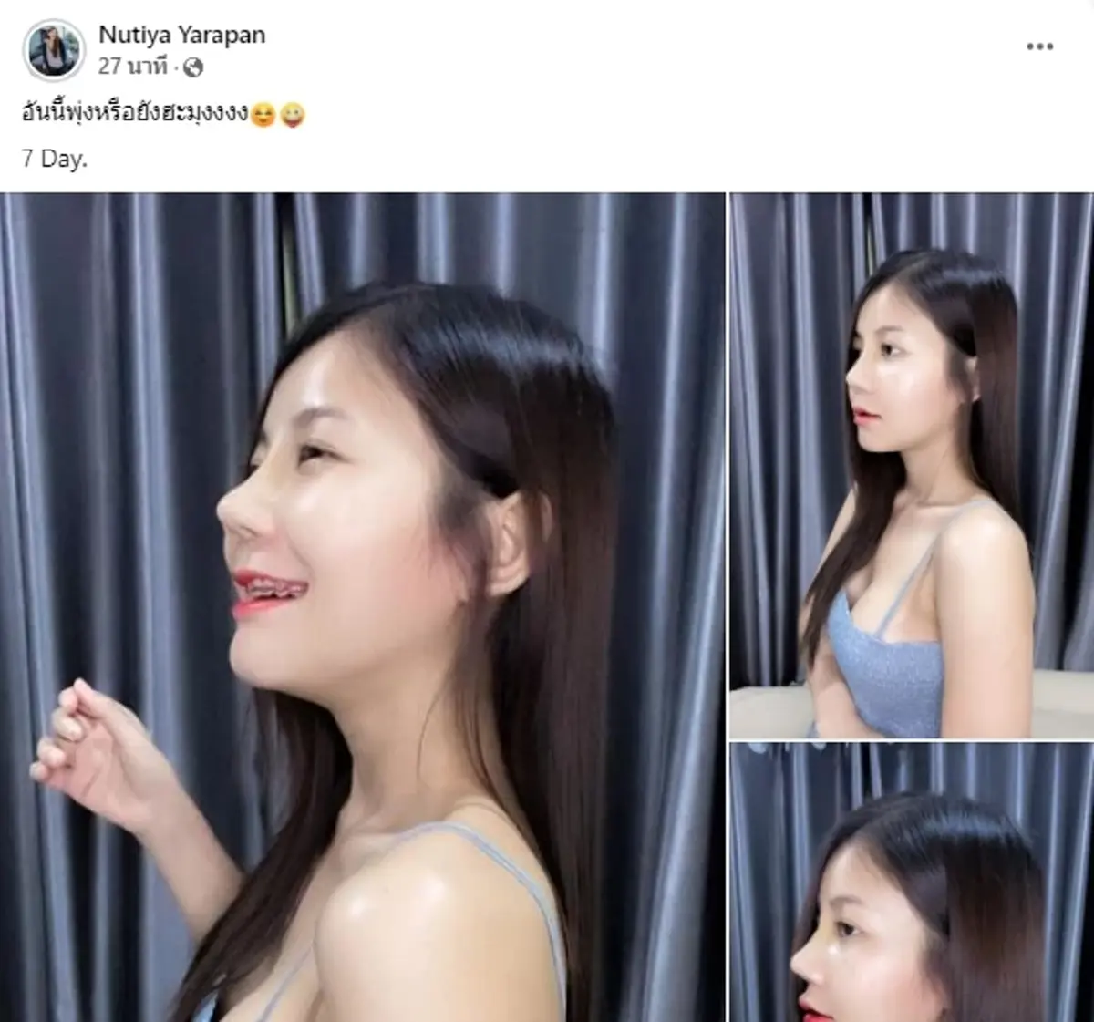 ภาพล่าสุด ครูเบียร์ แฟนเนเงิน เสริมจมูก ทำจมูก
