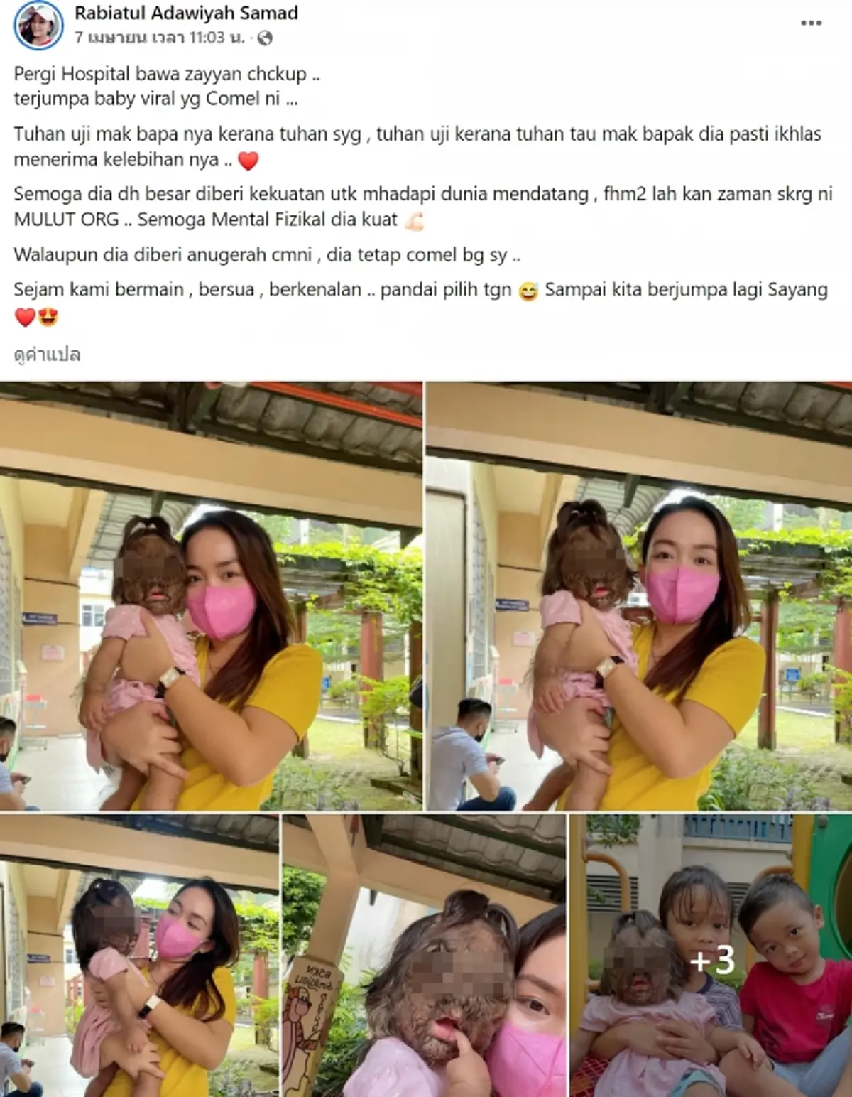 โซเชียลฮือฮา หนูน้อยหน้าขน ครอบครัวเผยเป็นของขวัญพิเศษจากพระเจ้า
