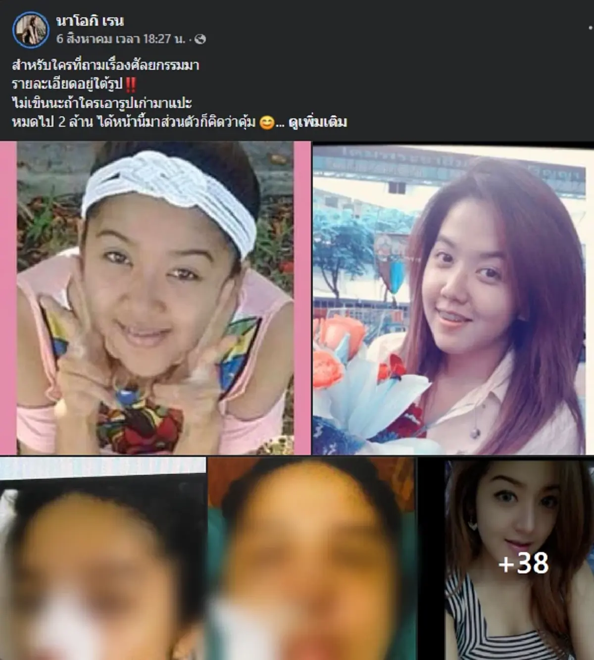 นัส จุฑารัตน์ เปิดหน้าเก่า ให้ดูจะๆ หลังหมดค่าศัลยกรรมไป 2 ล้าน