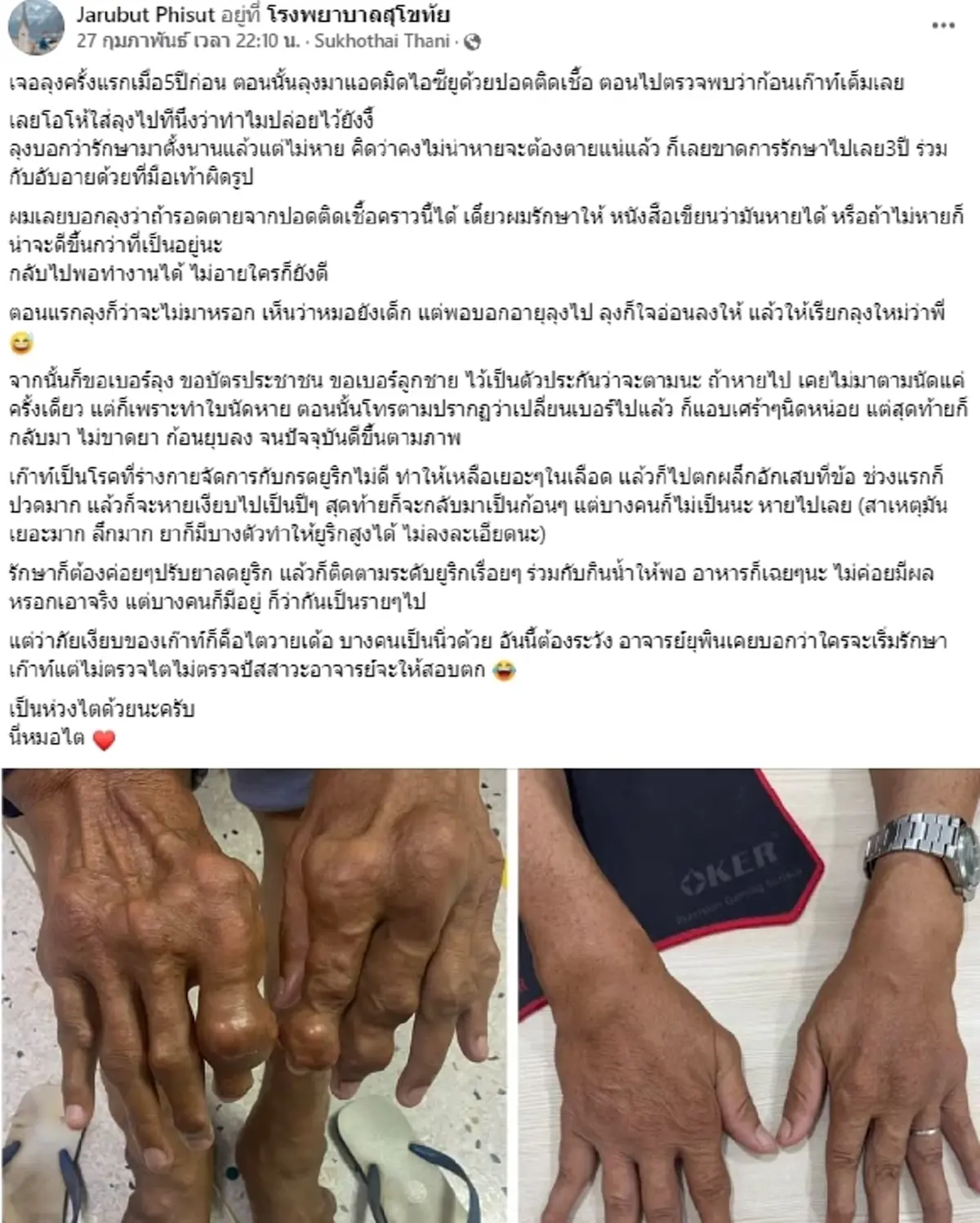 \'หมอสุโขทัย\' รักษาลุงป่วยโรคเก๊าท์ จากมือ - เท้าผิดรูป